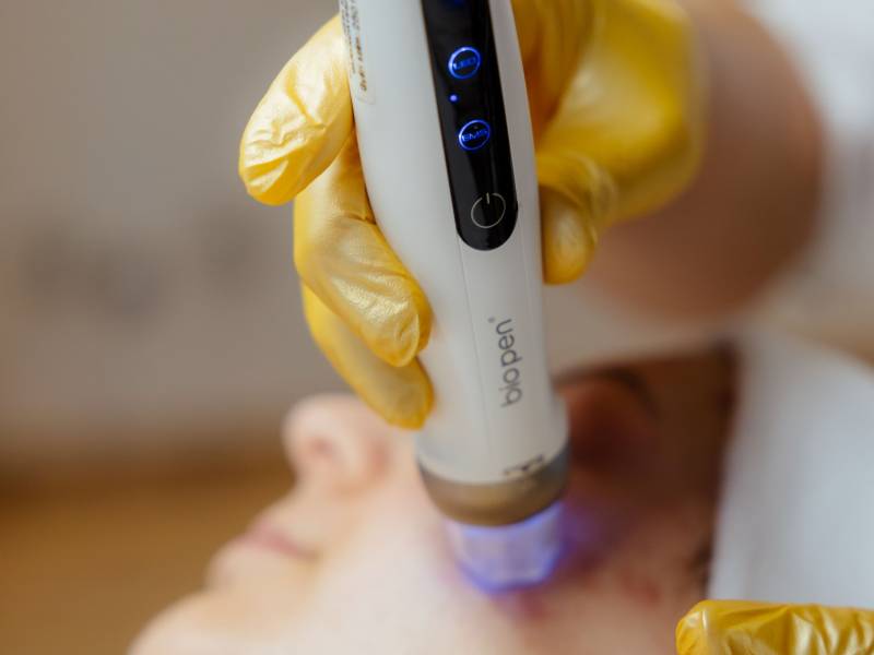 Biopenes kezelés pigmentfoltok ellen